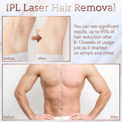 Aopvui At-Home IPL Hair Removal